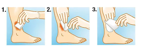 SUPRASORB A+Ag  antimikrobiális kálcium-alginát kötszer ezüsttel 5 x 5 cm