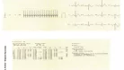 EKG készülék HeartScreen 80GL1