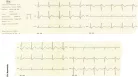EKG készülék HeartScreen 80GL1