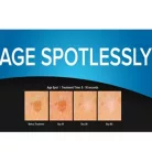 CRYOCLEAR fagyasztó toll  60x5s kezelésre