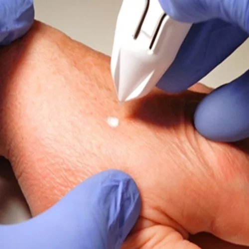 CRYOCLEAR fagyasztó toll  60x5s kezelésre