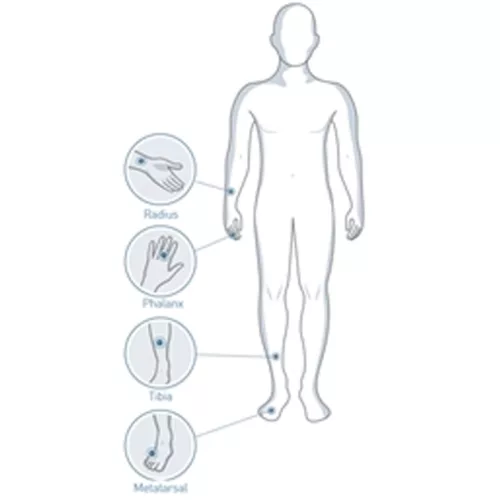 SUNLIGHT MINIOMNI ultrahangos csontrikulás szűrő gép (fej + szoftver) - Méret felnőtt + gyerek