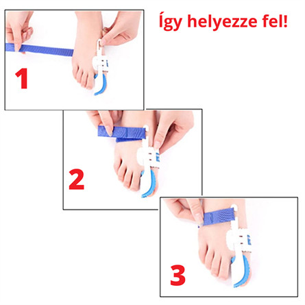 Éjszakai bütyökkorrigáló sín